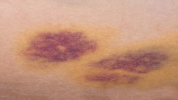 Cinsel Organda Morluk Neden Olur?