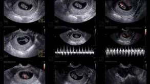 7 Haftalık Gebelik Kese Var Bebek Yok!