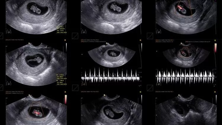 7 Haftalık Gebelik Kese Var Bebek Yok!